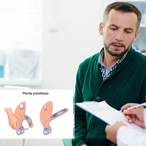 Welcome to   Florida Urology Partners 
: Understanding Penile Implants